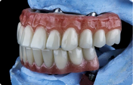 An Alternative To Removable Dentures
If you've been wearing removable dentures for a while, full arch implants offer a non-removable option, anchored to the jawbone rather than sitting on your gums. That said, fixed teeth aren't for everyone. Some patients like keeping the option of taking their dentures out, and snap-on dentures might suit them better. We'll talk through the trade-offs with you at your consultation.