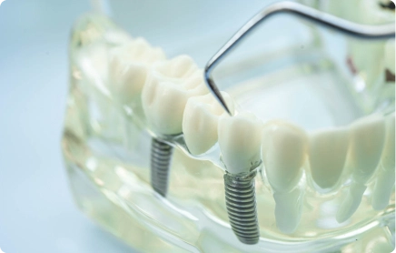 Implant-Supported Bridges
If you've got several missing teeth in a row, an implant-supported bridge can replace them using fewer implants than one-per-tooth. We place two implants at either end of the gap and fix a bridge of three or more crowns between them, anchored to the implants rather than your natural teeth.