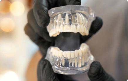 Multiple Dental Implants
For patients with two or more missing teeth. Depending on the number and position of the gaps, we might recommend separate implants for each tooth, or fewer implants supporting a small bridge between them. In a consultation we'll show you the options available for replacing multiple missing teeth and explain the trade-offs.