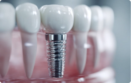 Single Dental Implants
A single tooth implant gives you a standalone replacement that doesn't rely on the teeth either side, so unlike dental bridges, your neighbouring teeth stay untouched. This is often the preferred option when one tooth is missing and the rest of your teeth are healthy.